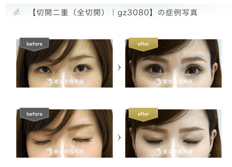 東京美容外科の切開症例写真